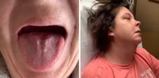 Neurologische aanvallen na Coronavaccinatie
