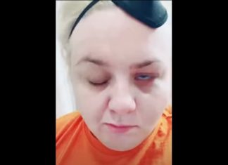Covid verpleegster krijgt Bell’s Palsy na het Pfizer Covid-19 vaccin