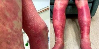 Extreme vaccin-schade: 74-jarige man verliest huid na Covid-19 vaccin