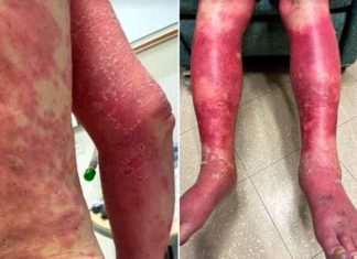 Extreme vaccin-schade: 74-jarige man verliest huid na Covid-19 vaccin