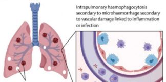 Cardioloog waarschuwt voor Covid-19 vaccins fraude en hyper-inflammatoire immuunreacties veroorzaakt door de injecties