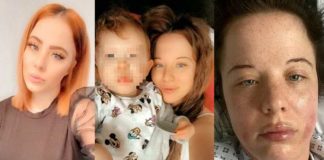 Pfizer bezorgt Britse vrouw anafylactische schokken, maar zij beveelt de injectie toch aan zodat wij net zoals haar kunnen lijden
