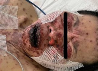 Toxische Epidermale Necrolyse: 49-jarige vrouw uit New York krijgt één week na Pfizer mRNA-injectie levensbedreigende huidrotstoornis