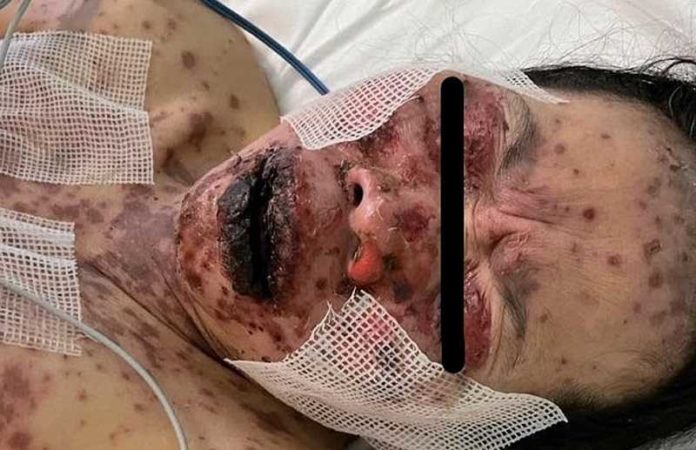 Toxische Epidermale Necrolyse