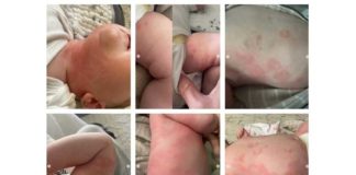 Baby krijgt enorme uitslag na COVID-19 vaccinatie van moeder die borstvoeding geeft