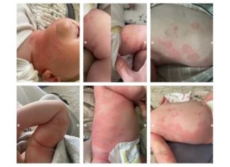 Baby krijgt enorme uitslag na COVID-19 vaccinatie van moeder die borstvoeding geeft