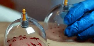 Hijama of “cupping “: Wanhopige werknemers, studenten gedwongen tot vaccinmandaten wenden zich tot een eeuwenoude behandeling om de injecties na toediening te verwijderen