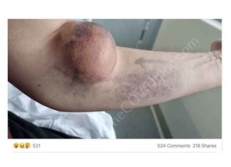 Britse man tijdelijk verbannen van Facebook na delen gruwelijke foto van na-AstraZeneca, honkbalgrote bloedprop in zijn arm