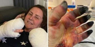 Volledig gevaccineerde vrouw acht vingers geamputeerd nadat ze zwart werden door “mysterieuze ziekte”