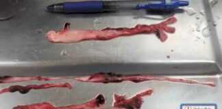 Hier is hoe het vaccin die rare “bloedklonters” veroorzaakt