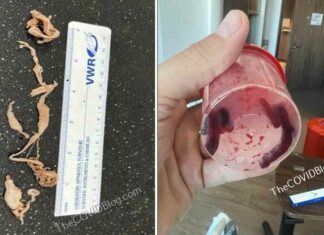 Man vermijdt amputatie nadat Turkse artsen verschillende 10 centimeter lange bloedklonters uit zijn been hebben getrokken