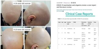 Gevallen van alopecia (haaruitval) exploderen na COVID-19 vaccins