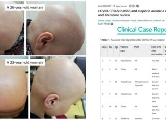 Gevallen van alopecia (haaruitval) exploderen na COVID-19 vaccins