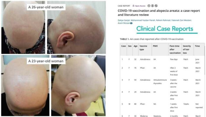 Hair-loss-after-COVID-vaccines kaal