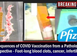 Gevolgen van COVID-vaccinatie vanuit het perspectief van een patholoog – Decimeters-lange bloedklonters, kanker, onvruchtbaarheid
