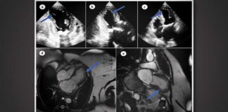 “Ballonhart” na vaccinatie: gentherapiemedicijnen veroorzaken zeldzame vorm van cardiomyopathie