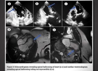 “Ballonhart” na vaccinatie: gentherapiemedicijnen veroorzaken zeldzame vorm van cardiomyopathie