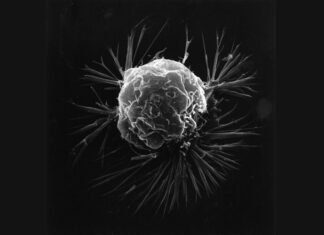 Wanneer minder weten meer is: over kankerscreening