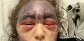23-jarige vrouw ontwikkelt blindheid en auto-immuunziekte nadat artsen haar dwongen drie vaccininjecties te krijgen