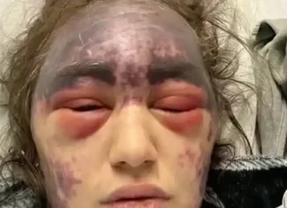 23-jarige vrouw ontwikkelt blindheid en auto-immuunziekte nadat artsen haar dwongen drie vaccininjecties te krijgen